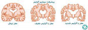 زوال عقل و آلزایمر