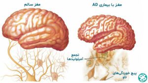 آلزایمر