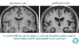 زوال عقل