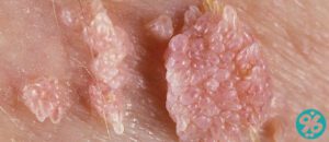 HPV در زنان