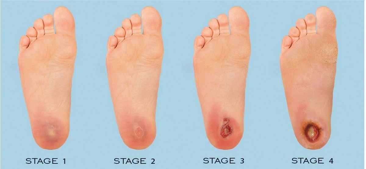 مراحل پیشرفت زخم دیابتی