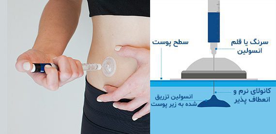 مشخصات پورت تزریق انسولین آی پورت