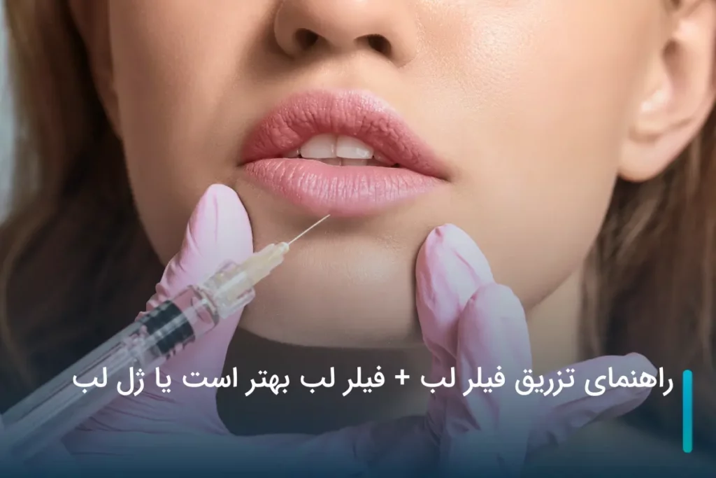 راهنمای تزریق فیلر لب + فیلر لب بهتر است یا ژل لب؟