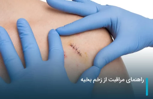 راهنمای مراقبت از زخم بخیه