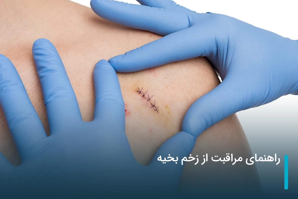 راهنمای مراقبت از زخم بخیه