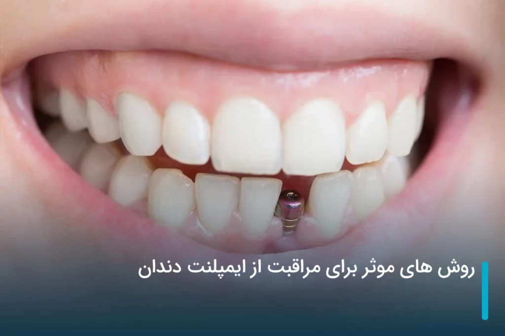 روش های موثر برای مراقبت از ایمپلنت دندان