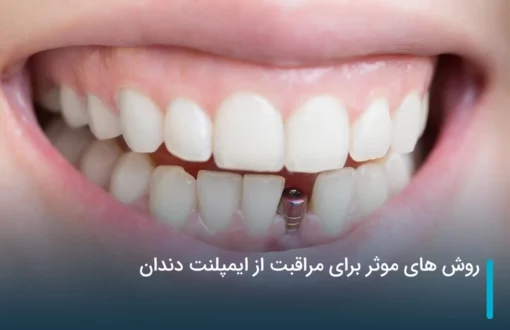 روش های موثر برای مراقبت از ایمپلنت دندان