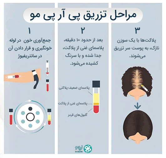 مراحل تزریق پی آر پی مو