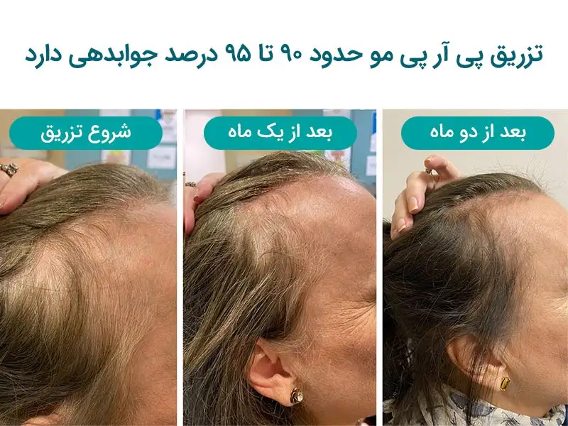 پی آر پی مو چند درصد جواب میده؟