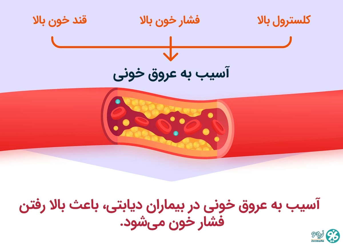 آسیب به عروق در بیماری دیابت