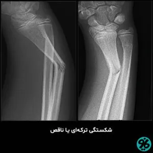 شکستگی-ارتوپدی