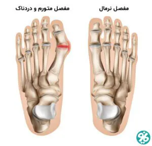 شکستگی مفصل و استخوان و ارتوپدی
