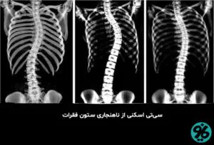 کجی ستون فقرات و ارتوپدی